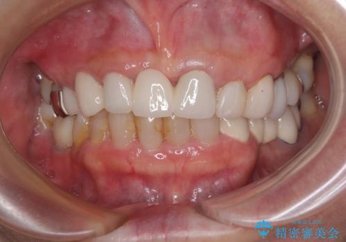 割れてしまった歯と深いむし歯 部分矯正と外科処置で安定したブリッジ治療の治療後