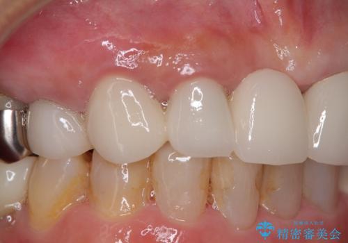 割れてしまった歯と深いむし歯 部分矯正と外科処置で安定したブリッジ治療の治療後