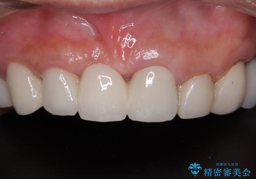 割れてしまった歯と深いむし歯 部分矯正と外科処置で安定したブリッジ治療の症例 治療後