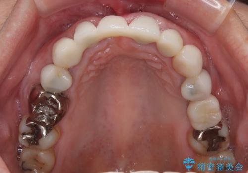 割れてしまった歯と深いむし歯　部分矯正と外科処置で安定したブリッジ治療の治療後