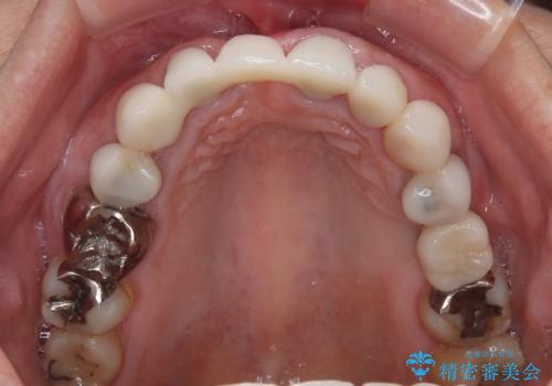 割れてしまった歯と深いむし歯 部分矯正と外科処置で安定したブリッジ治療の治療後