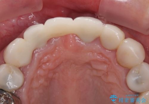 割れてしまった歯と深いむし歯 部分矯正と外科処置で安定したブリッジ治療の治療後