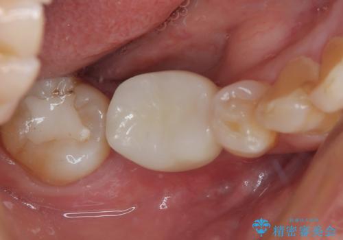 割れてしまった奥歯 インプラントによる補綴治療の症例 治療後
