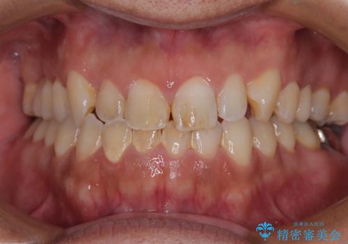 放置していたむし歯 抜歯即時埋入インプラントで負担を軽減の治療後