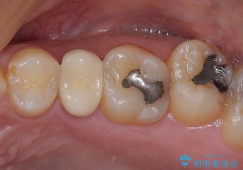 放置していたむし歯 抜歯即時埋入インプラントで負担を軽減の治療後