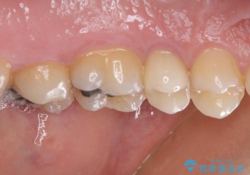 放置していたむし歯 抜歯即時埋入インプラントで負担を軽減の治療後