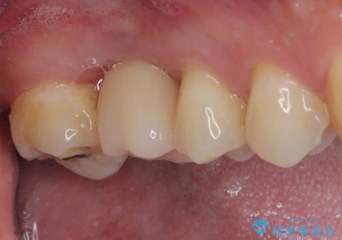 放置していたむし歯　抜歯即時埋入インプラントで負担を軽減の治療後