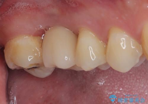放置していたむし歯 抜歯即時埋入インプラントで負担を軽減の治療後