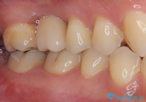 放置していたむし歯 抜歯即時埋入インプラントで負担を軽減の治療後