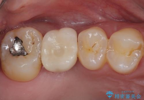 放置していたむし歯　抜歯即時埋入インプラントで負担を軽減の治療後