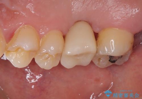 放置していたむし歯 抜歯即時埋入インプラントで負担を軽減の治療後