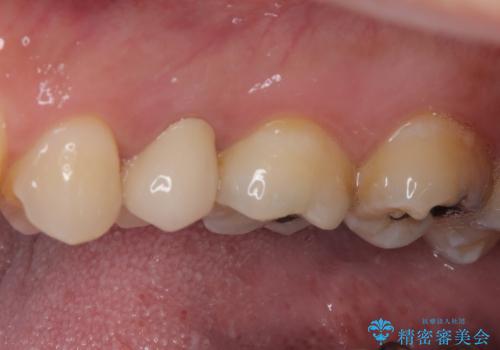 放置していたむし歯　抜歯即時埋入インプラントで負担を軽減の治療後