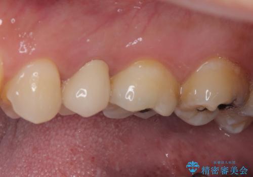 放置していたむし歯 抜歯即時埋入インプラントで負担を軽減の治療後