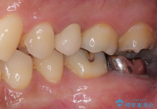 放置していたむし歯　抜歯即時埋入インプラントで負担を軽減の治療後