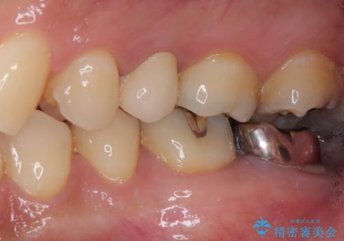 放置していたむし歯 抜歯即時埋入インプラントで負担を軽減の治療後