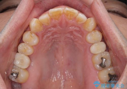 放置していたむし歯 抜歯即時埋入インプラントで負担を軽減の治療後