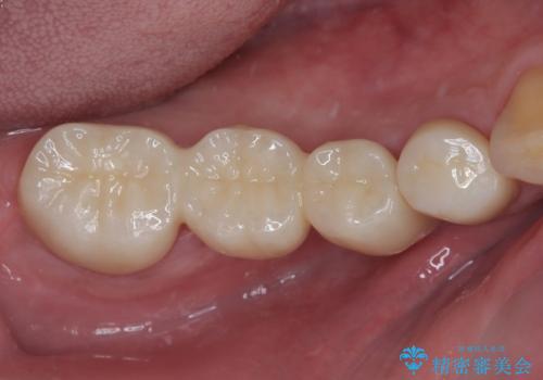 詰め物が割れた フルジルコニアクラウンの治療後
