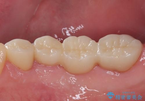 詰め物が割れた フルジルコニアクラウンの治療後