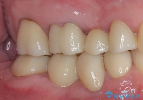 詰め物が割れた フルジルコニアクラウンの治療後