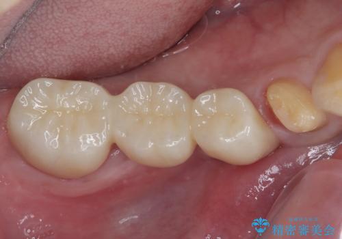 詰め物が割れた フルジルコニアクラウンの治療中