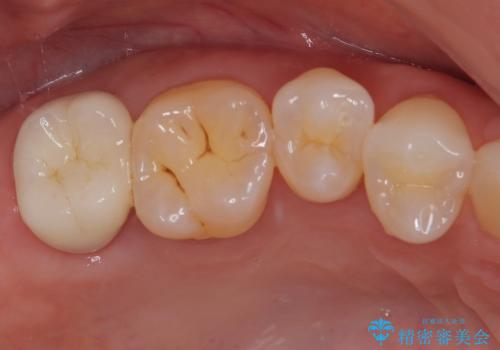 食事をすると痛む奥歯　オールセラミッククラウンでのむし歯治療の治療後