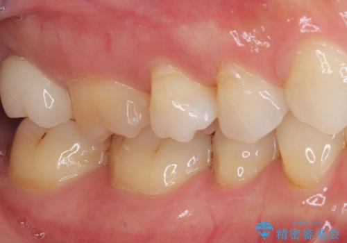 食事をすると痛む奥歯　オールセラミッククラウンでのむし歯治療の治療後