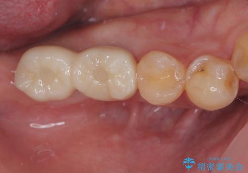 抜歯したところにインプラント治療をしたい。の症例 治療後