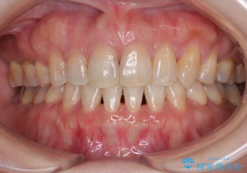 抜歯矯正 ワイヤー装置で横顔の印象を改善の症例 治療後