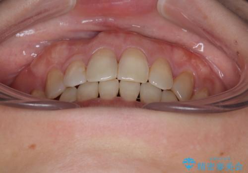 抜歯矯正 ワイヤー装置で横顔の印象を改善の治療後