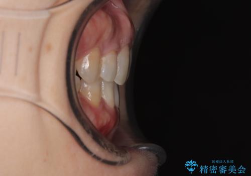 抜歯矯正 ワイヤー装置で横顔の印象を改善の治療後