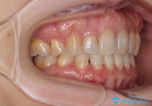 抜歯矯正 ワイヤー装置で横顔の印象を改善の治療後