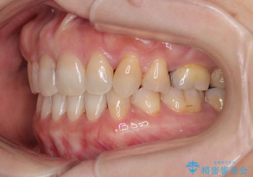 抜歯矯正 ワイヤー装置で横顔の印象を改善の治療後