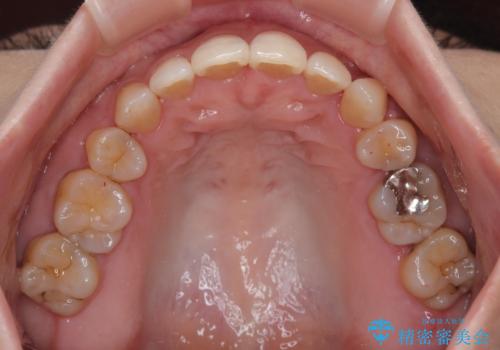 抜歯矯正 ワイヤー装置で横顔の印象を改善の治療後