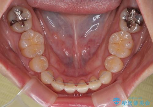 抜歯矯正 ワイヤー装置で横顔の印象を改善の治療後