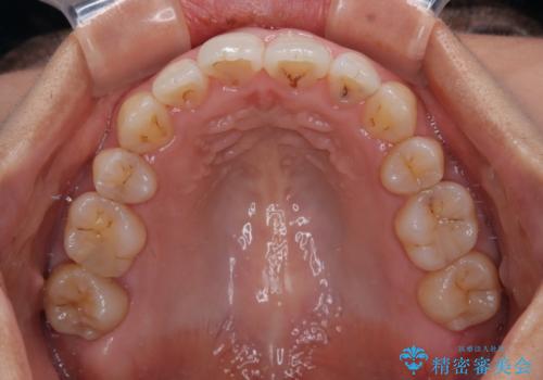 前歯のデコボコを改善　インビザラインの矯正治療の治療後
