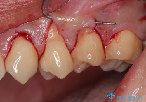冷たいものがしみる 歯肉移植術で根面被覆の治療中