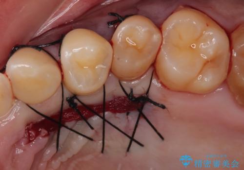 冷たいものがしみる 歯肉移植術で根面被覆の治療中