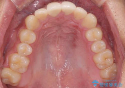 前歯を綺麗にしたい。の治療後