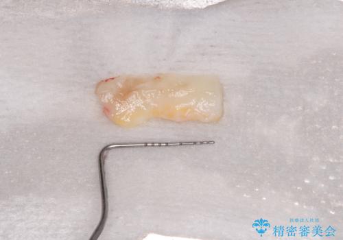 冷たいものがしみる 歯肉移植術で根面被覆の治療中