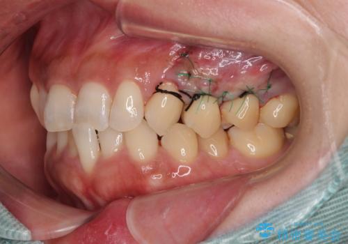 冷たいものがしみる 歯肉移植術で根面被覆の治療中