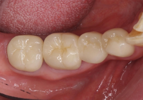 70代女性 状態の悪い歯を抜歯して、奥歯をブリッジにの治療後