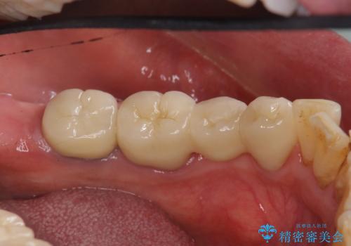 70代女性 状態の悪い歯を抜歯して、奥歯をブリッジにの治療後
