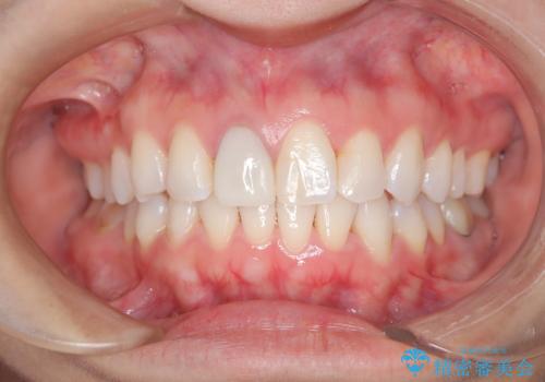 根管治療と並行して矯正を マウスピース治療の治療中