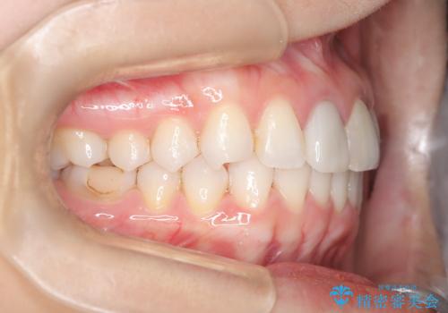 根管治療と並行して矯正を マウスピース治療の治療中