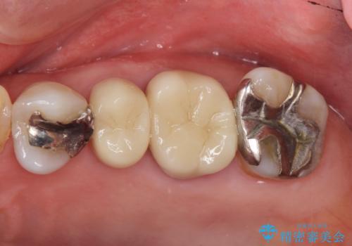 70代女性 段差のある被せ物のやり替え の治療後