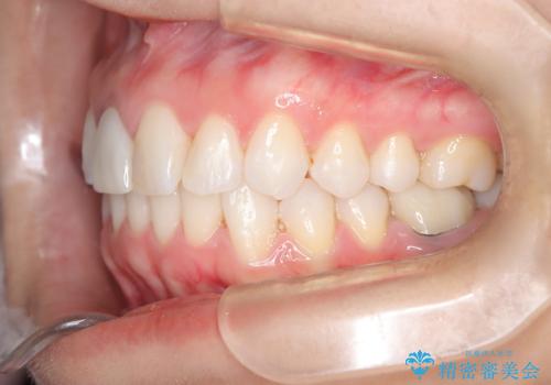 根管治療と並行して矯正を マウスピース治療の治療中