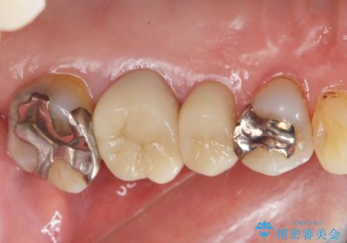 70代女性 段差のある被せ物のやり替え の治療後