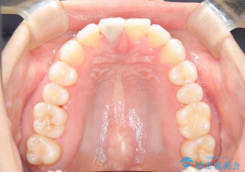根管治療と並行して矯正を マウスピース治療の治療中