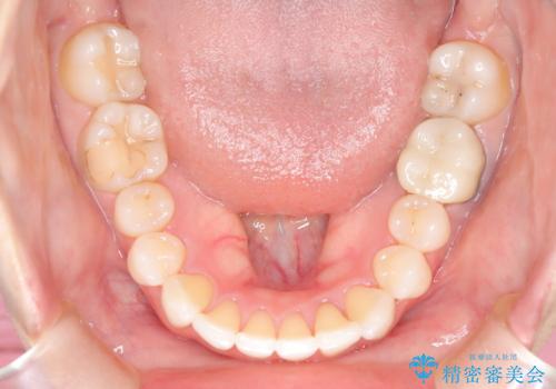 根管治療と並行して矯正を マウスピース治療の治療中