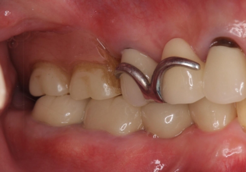 70代女性 状態の悪い歯を抜歯して、奥歯をブリッジにの治療後